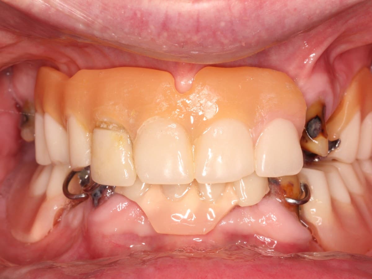 Full-arch rehabilitation, before treatment