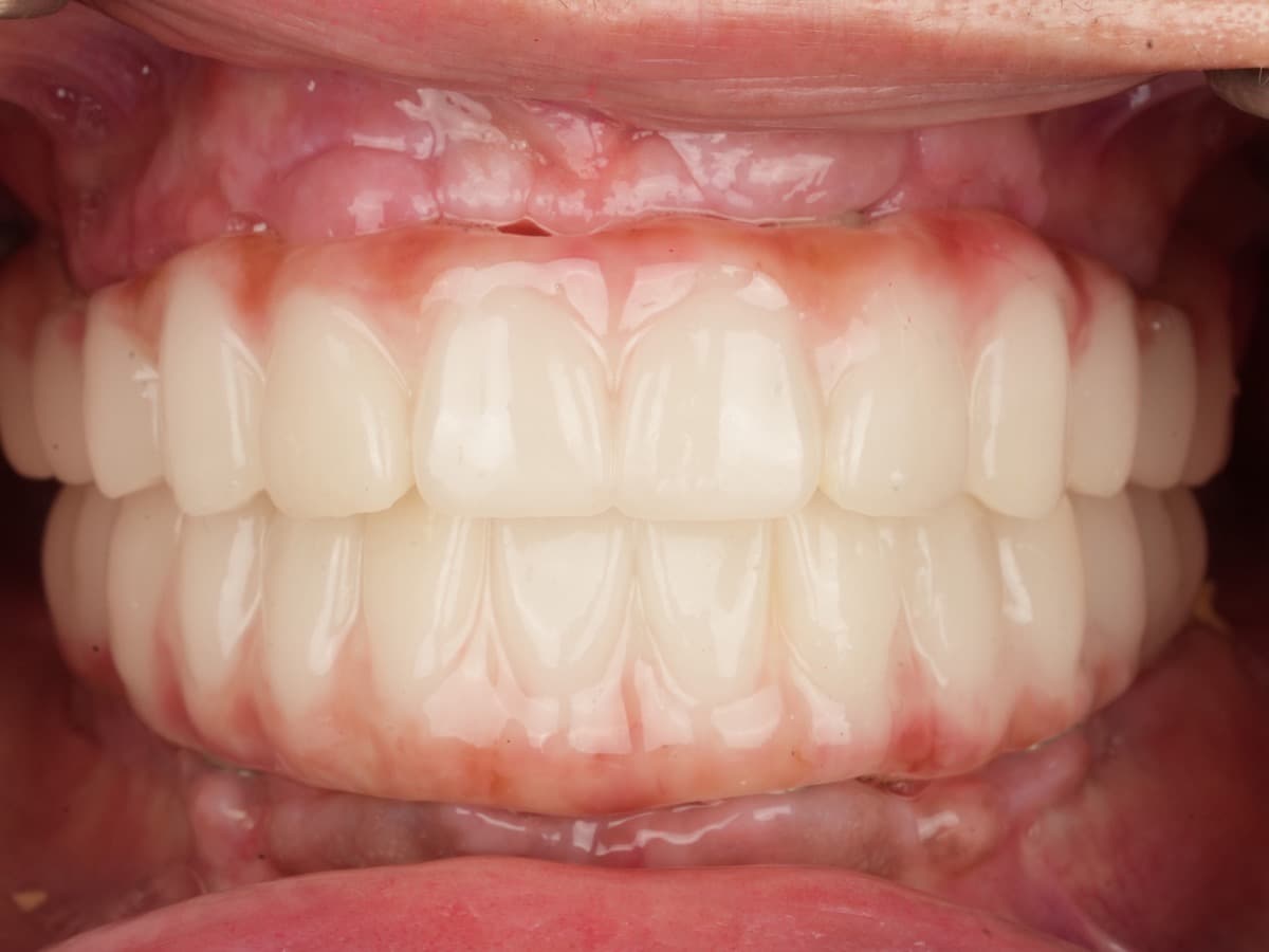Full-arch implant rehabilitation outcome