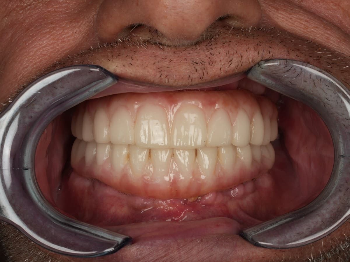 Fixed full-arch implant-supported restoration