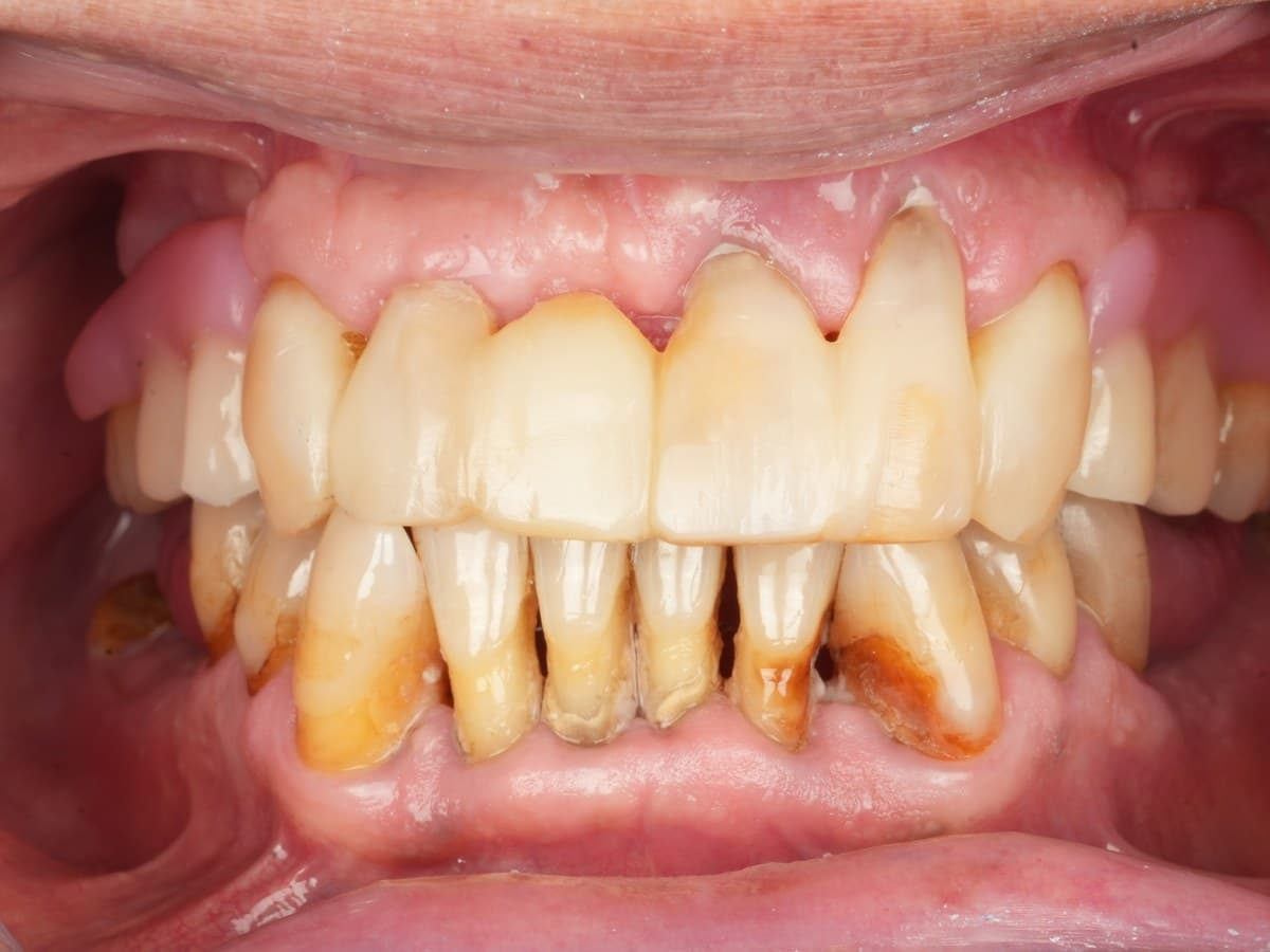 Before treatment