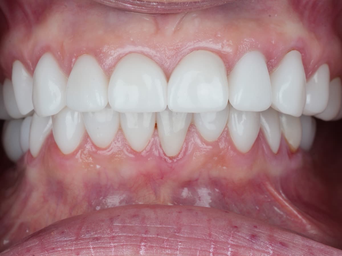 Completed full-arch implant case