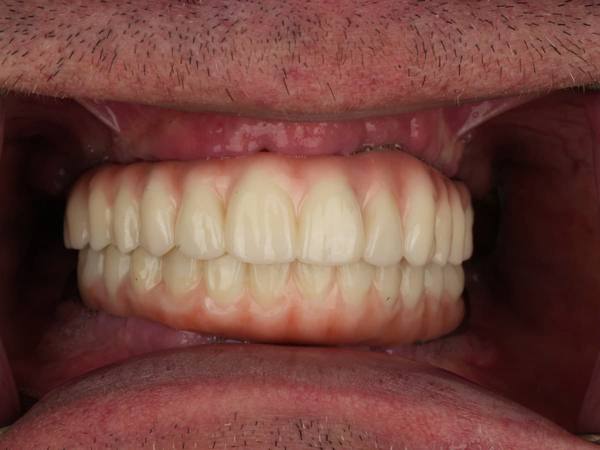 Full-arch implant case, after implant placement